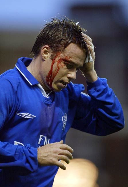 Ei chiar si-au dat sangele pentru fotbal! Vezi cei mai RUPTI jucatori din Anglia_9