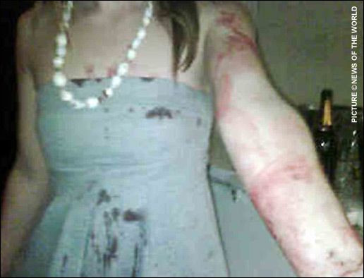 FOTO: Imagini socante cu studenta desfigurata de Marlon King de la Wigan!_3