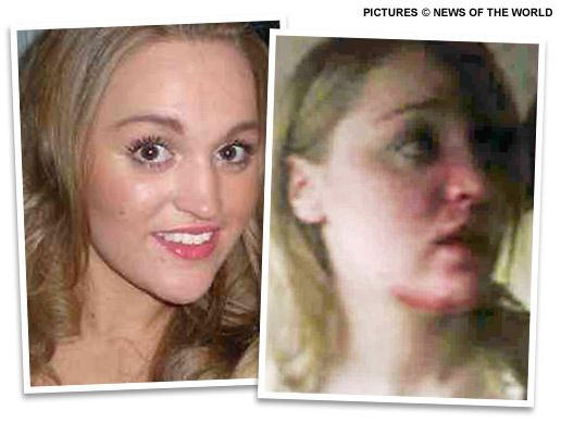 FOTO: Imagini socante cu studenta desfigurata de Marlon King de la Wigan!_4