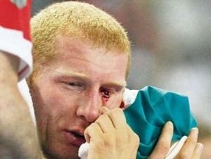 FOTO SOCANT! Unul dintre cei mai buni handbalisti ai lumii si-a pierdut UN OCHI pe teren! Vrea sa joace in continuare