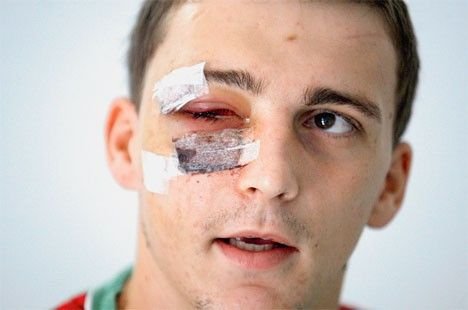 FOTO: Cum arata croatul bagat in spital de dinamovistul Pulhac! Se vor razbuna croatii?