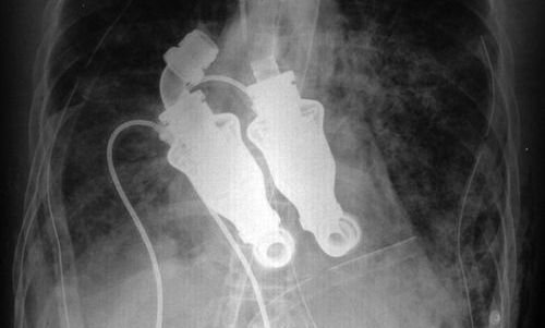 Descoperire FABULOSA in medicina! Primul om care traieste FARA INIMA! Vezi minunea care il tine in viata la 55 de ani: NU e niciun trucaj, am intrat intr-o noua ERA!_2