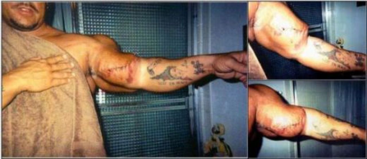FOTO: Culturistul cu cele mai umflate brate din lume! A bagat steroizi pana s-a INFECTAT iar apoi s-a operat singur!_1