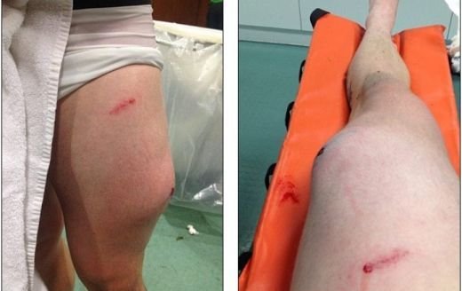 Eroul care a platit calificarea cu PICIORUL! Doctorii nu vad asa ceva in fiecare zi: 