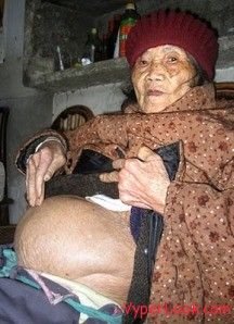 INCREDIBIL! O femeie a nascut o MUMIE! Cazul extrem de rar care a socat medicii din intreaga lume!_3