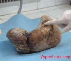 INCREDIBIL! O femeie a nascut o MUMIE! Cazul extrem de rar care a socat medicii din intreaga lume!_4