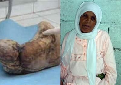 INCREDIBIL! O femeie a nascut o MUMIE! Cazul extrem de rar care a socat medicii din intreaga lume!_6