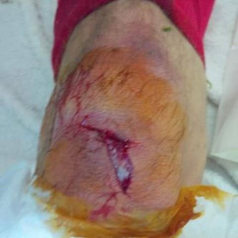 Accidentare ORIBILA la Arsenal! Un jucator are piciorul DISTRUS dupa meciul cu City! ATENTIE: imaginea este cu adevarat socanta:_2
