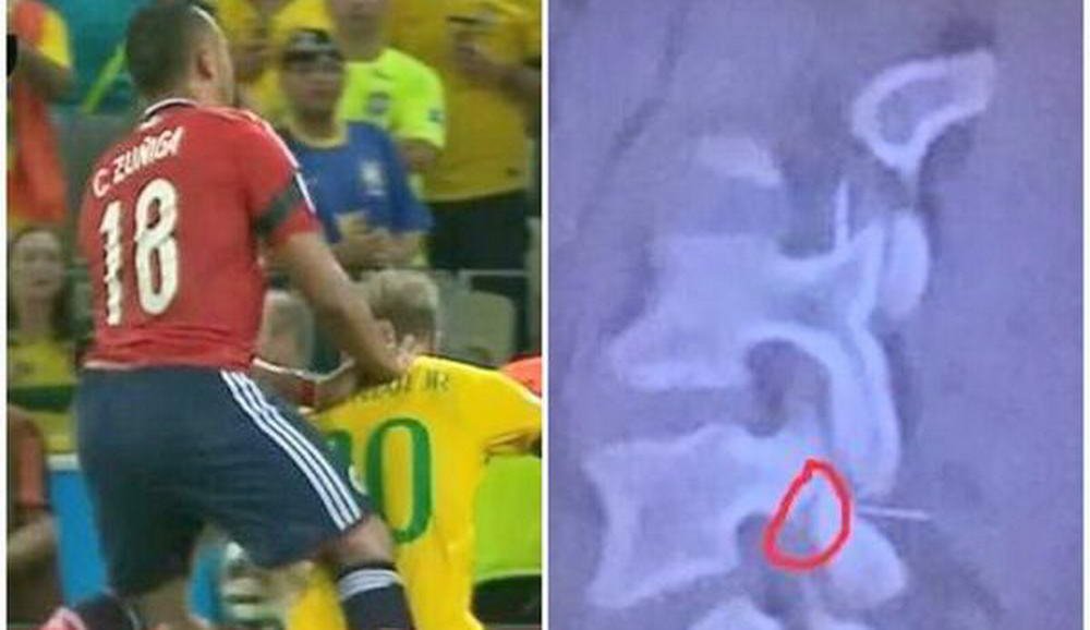 FOTO CUTREMURATOR! Neymar putea sa aiba soarta lui Nesu! Brazilianul a fost la 2 cm de drama! _4