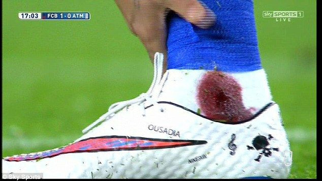 Imaginea horror de de la Barcelona - Atletico Madrid. Cum arata piciorul lui Neymar dupa aceasta intrare criminala. FOTO_3