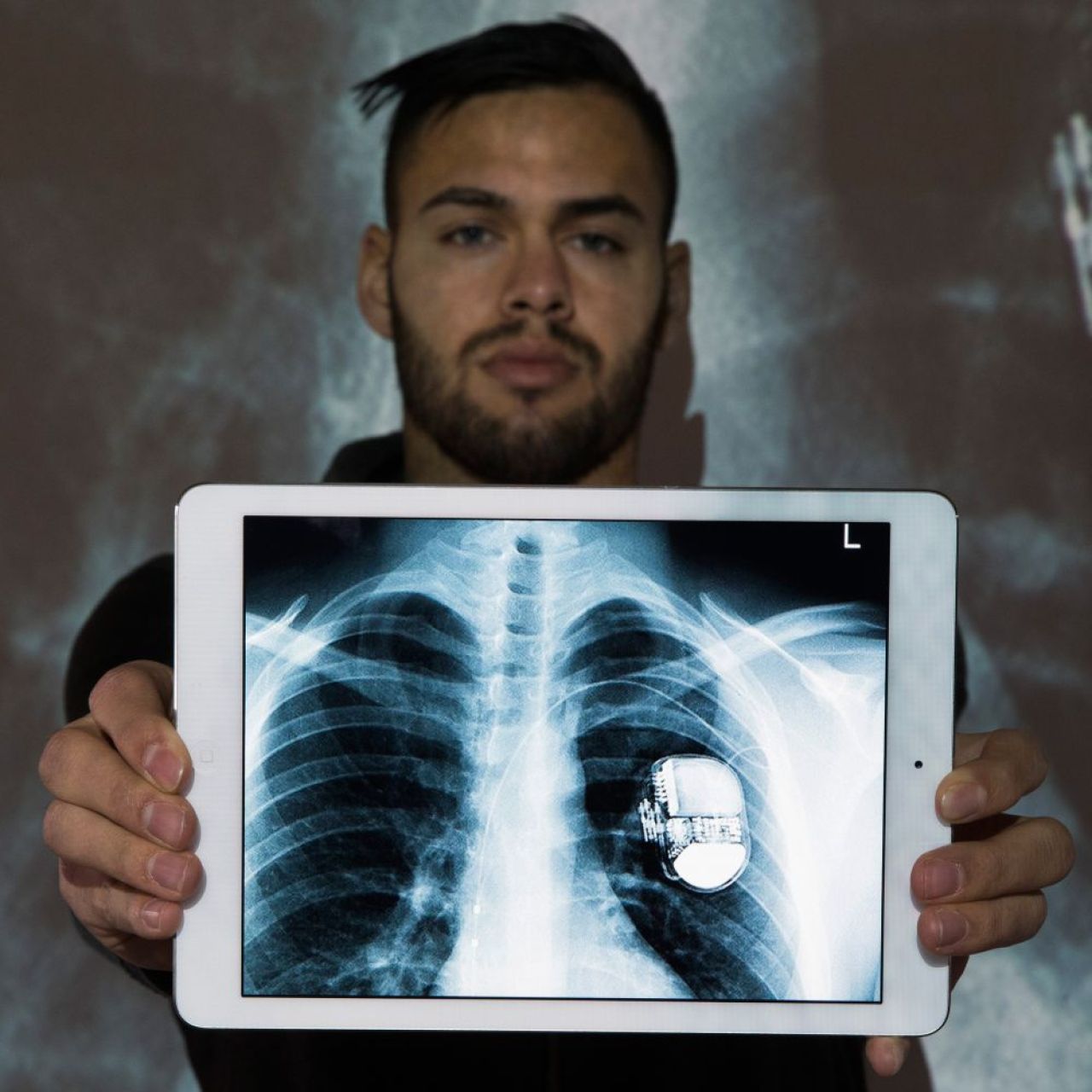 Inima ii bate pentru fotbal. Povestea unica a fotbalistului care a murit si inviat pe teren: ce si-a implantat ca sa mai joace_2