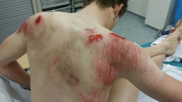 Imagini de cosmar! Cum arata spatele acestui ciclist dupa o cazatura horror. FOTO