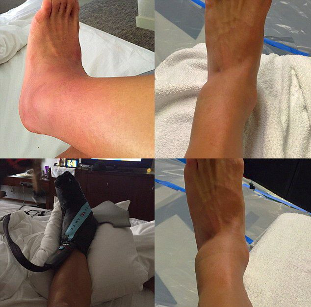 FOTO SOCANT | Pretul dur platit de Alexis Sanchez pentru trofeul Copei America. Cum arata piciorul jucatorului lui Arsenal, care s-a temut de o absenta indelungata_2