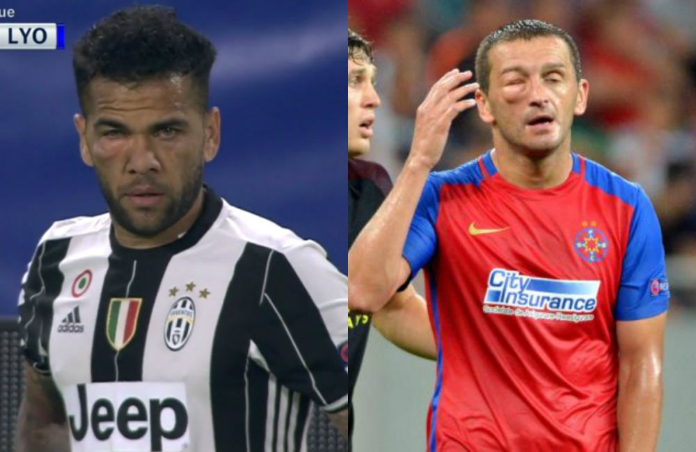 Are si Juventus un Golubovic . Dani Alves a terminat meciul cu Lyon cu ochiul umflat, la fel ca atacantul Stelei cu City