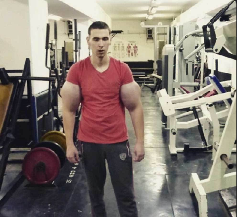 Popeye din Rusia! Si-a injectat synthol in brate, acum risca sa paralizeze: Are nevoie de ajutor psihiatric! FOTO