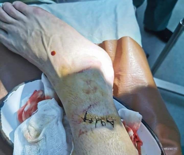 Imagini HORROR cu piciorul lui Barboianu! Cum arata dupa intrarea criminala a lui Sava! Atentie, imagini cu puternic impact emotional