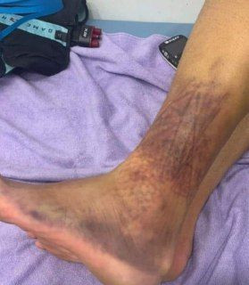 Peluza Catalin Hildan, mesaj emotionant pentru Catalin Straton! Imagini INCREDIBILE cu piciorul portarului inainte de meciul cu Botosani! Cum a putut sa joace&nbsp;