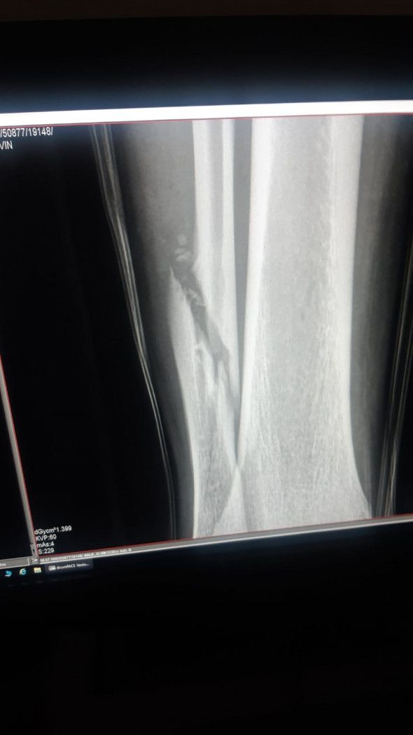 Primul verdict al medicilor de la Craiova in cazul Koljic: osul e RUPT! Radiografia arata ORIBIL