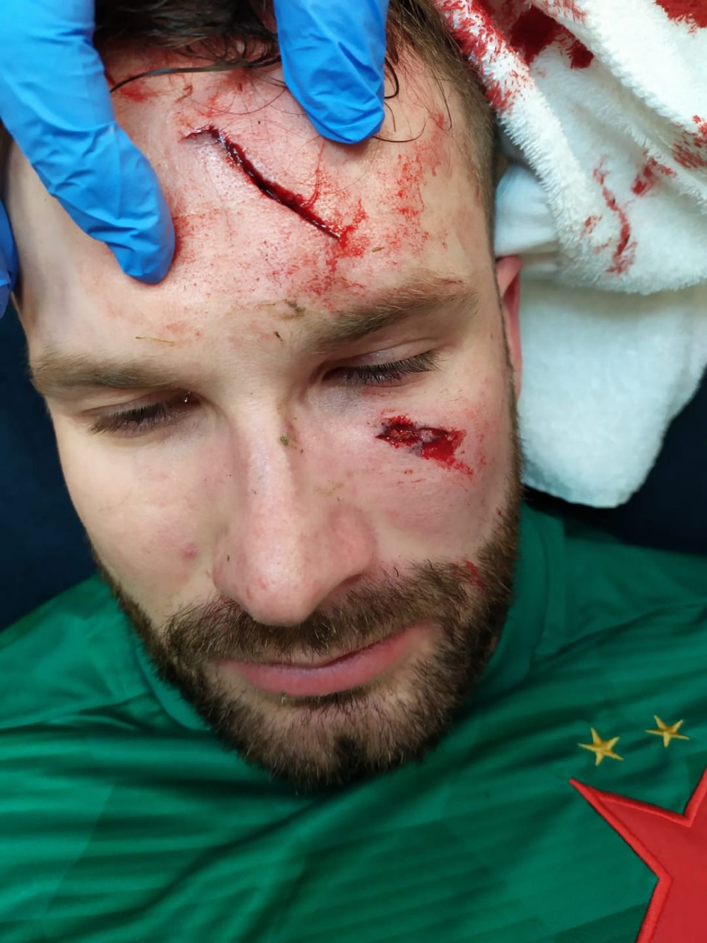 Atentie, imagini socante! Atac monstruos: i-a spart capul pur si simplu cu o lovitura dementa in Rangers - Slavia! Cum arata capul portarului dupa atac_22