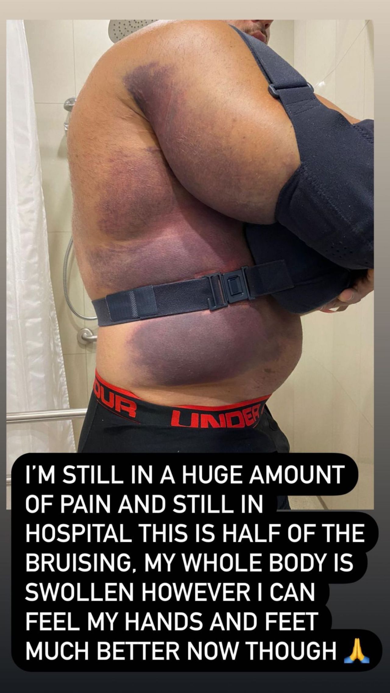 Sunt imaginile momentului! Cum poate arata dupa operatie sportivul care si-a distrus pieptul in timpul antrenamentelor! Imagini cu puternic impact emotional_5