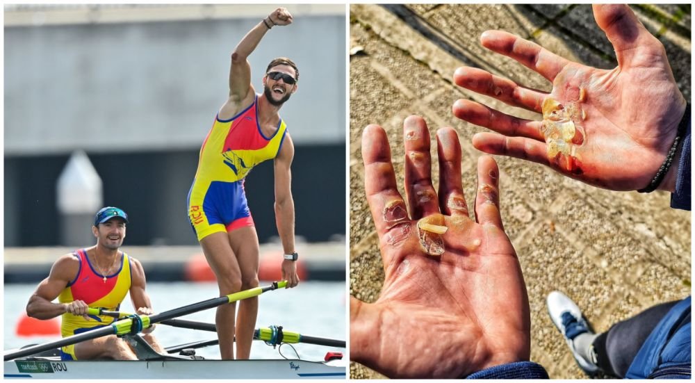 Suferințele din spatele unei medalii olimpice | Poza cu palmele lui Ciprian Tudosă, dovada sacrificiilor uriașe