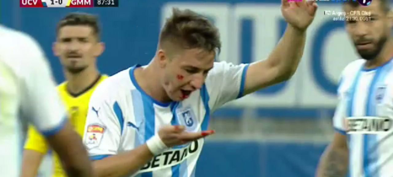 FOTO | Alex Mateiu, cu sârme și șuruburi în gură. Cum arată la o săptămână după incidentul din partida cu Gaz Metan _7