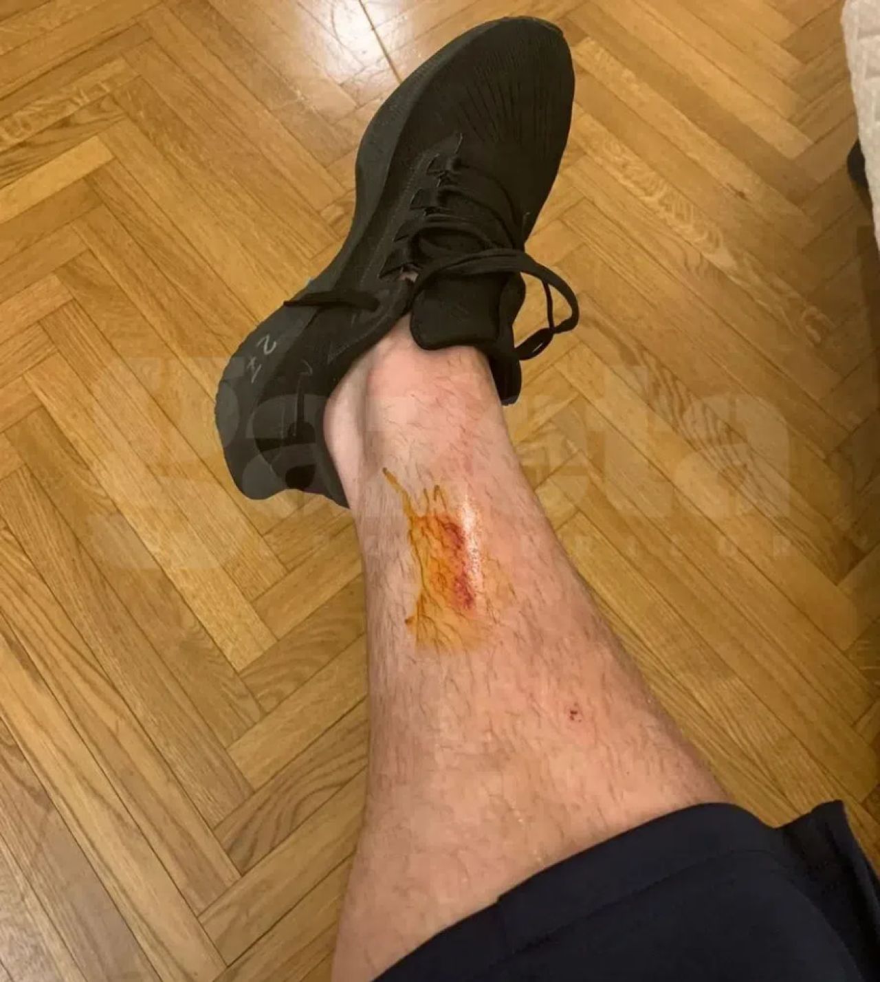 Cum arată piciorul lui Darius Olaru la o zi după faultul lui Susic: „S-a dus la spital! Nu mai simțea piciorul!”_1