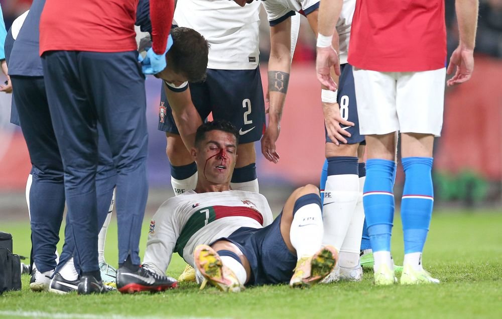 Imagini dure cu Cristiano Ronaldo! Fața i s-a umplut de sânge după o ciocnire cu portarul advers _3