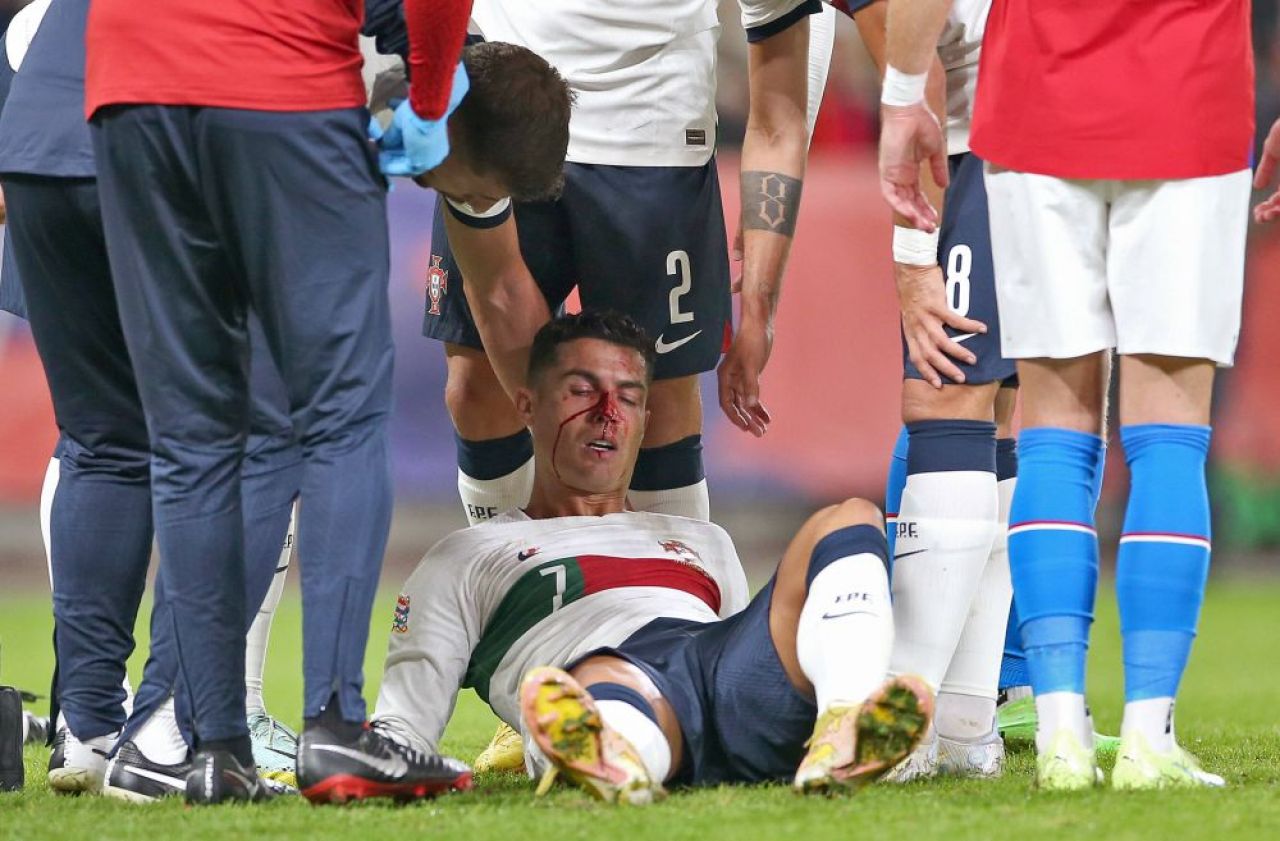 Imagini dure cu Cristiano Ronaldo! Fața i s-a umplut de sânge după o ciocnire cu portarul advers _7