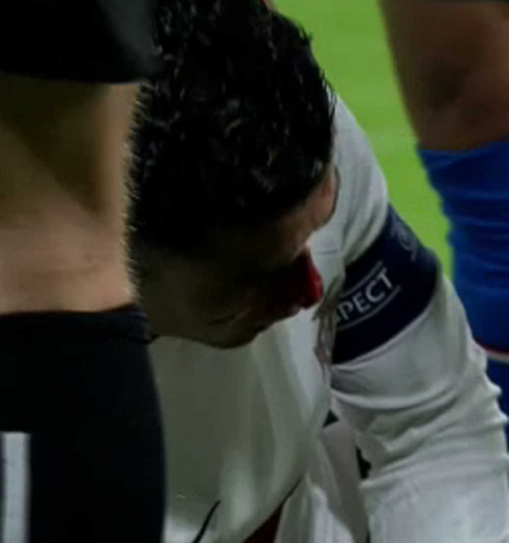 Accidentarea care l-a umplut de sânge a lăsat urme pe fața lui Cristiano Ronaldo! Cum a apărut azi portughezul _11