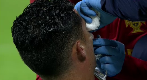 Accidentarea care l-a umplut de sânge a lăsat urme pe fața lui Cristiano Ronaldo! Cum a apărut azi portughezul _15