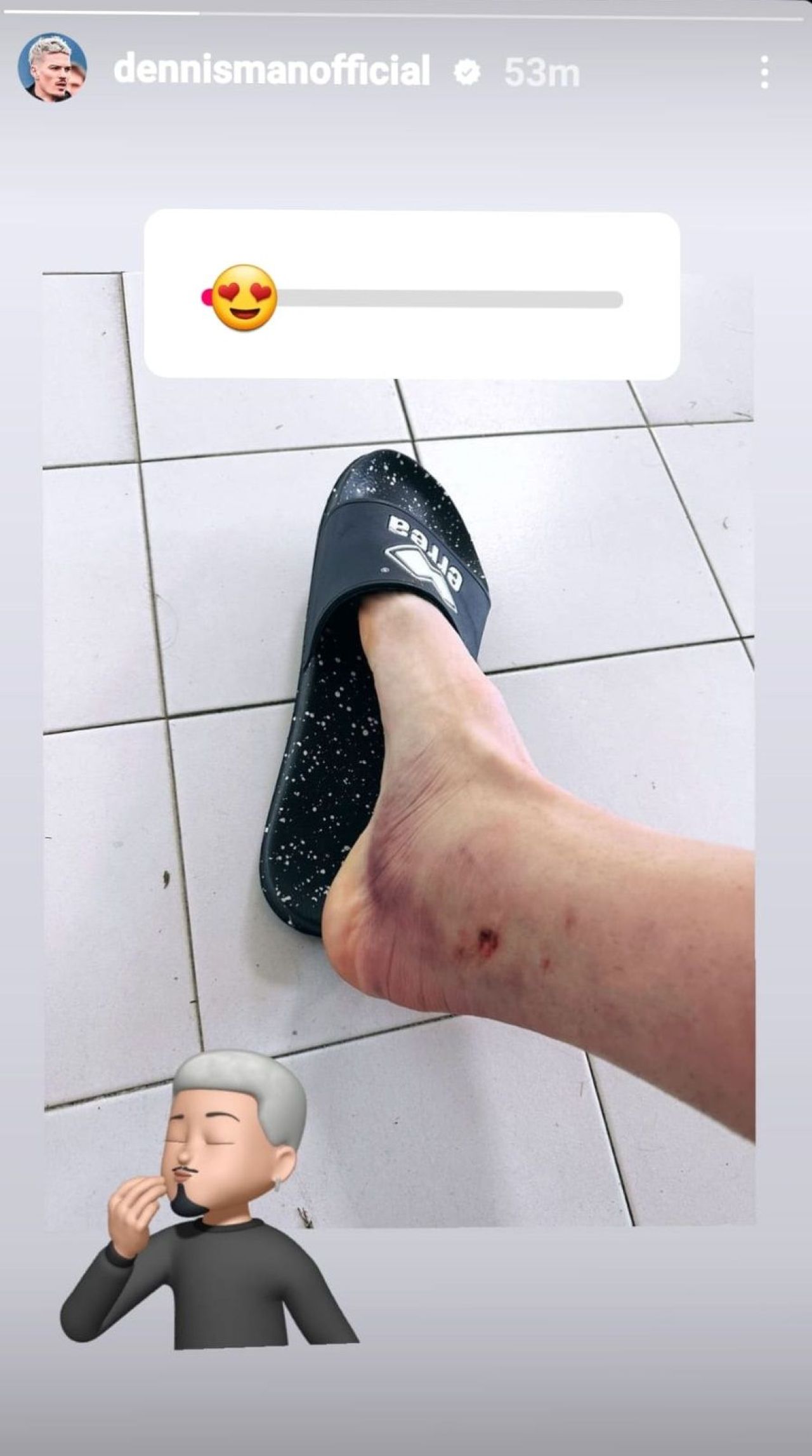 Cum poate arăta piciorul lui Dennis Man după ce s-a accidentat în ultimul meci _1