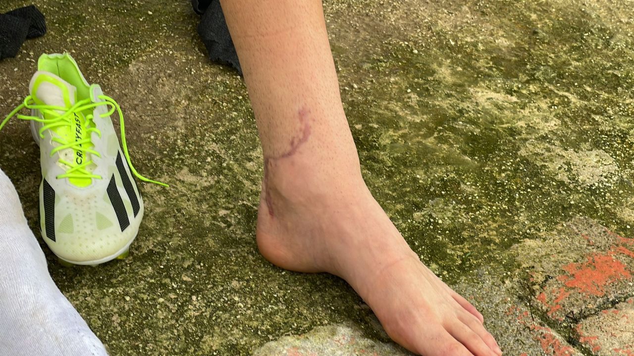 Cum arată piciorul lui Dragoș Iancu la trei luni și jumătate după accidentarea horror de la Ploiești_3