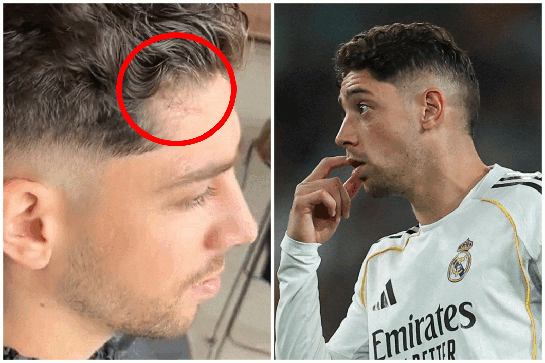 Federico Valverde a apărut cu o cicatrice uriașă după ce s-a bătut cu Tchouameni! Cum arată starul lui Real Madrid
